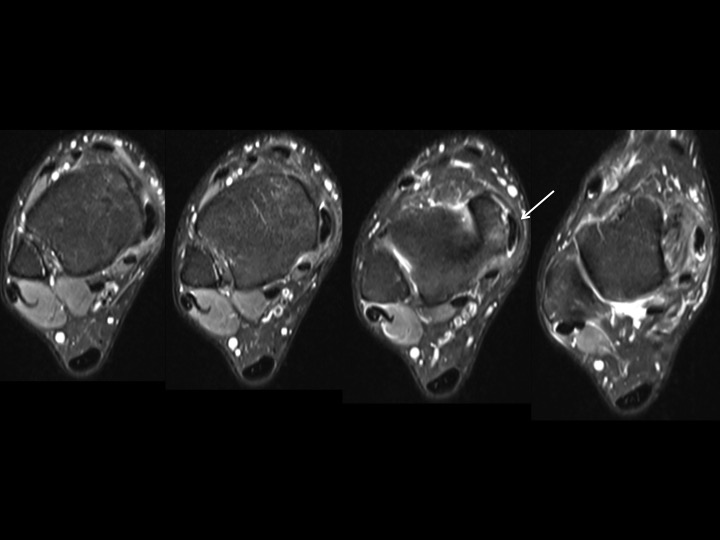Figure 2 for case flexor retinaculum ( RID2313 )